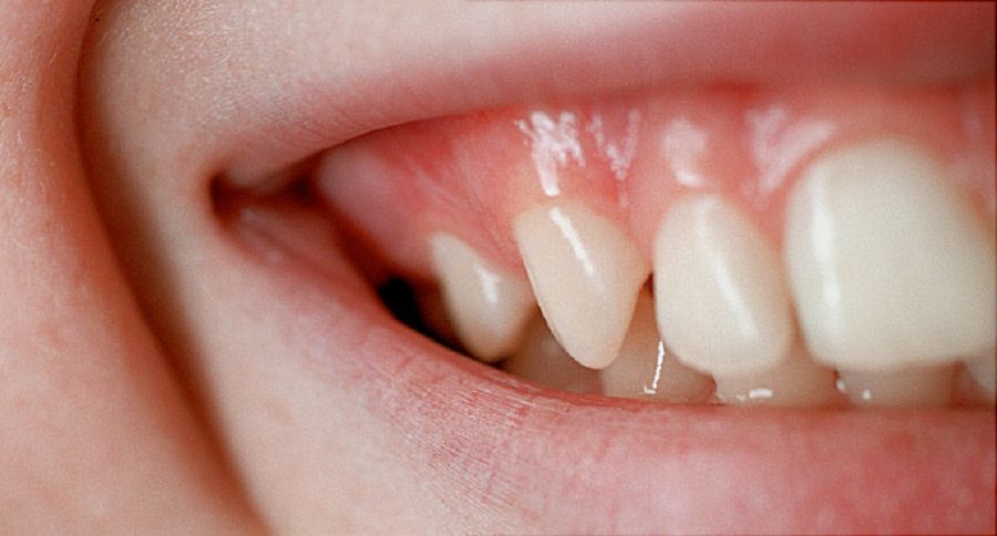 Poor Oral Health May Increase Gut Inflammation